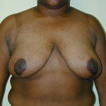 Breast Reduction 19 After Photo - 8