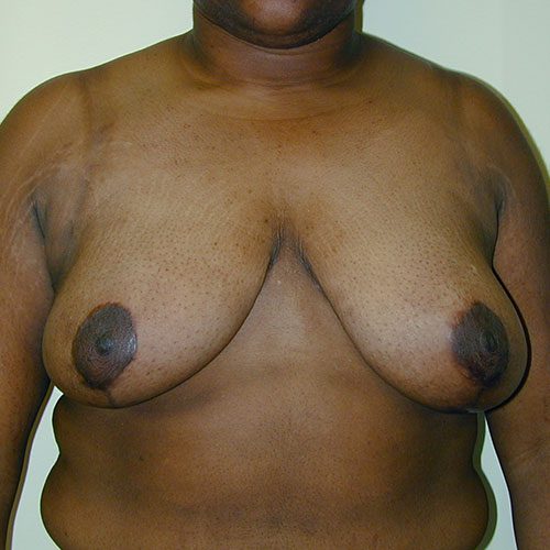 Breast Reduction 19 After Photo 