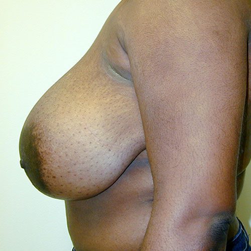 Breast Reduction 19 Before Photo