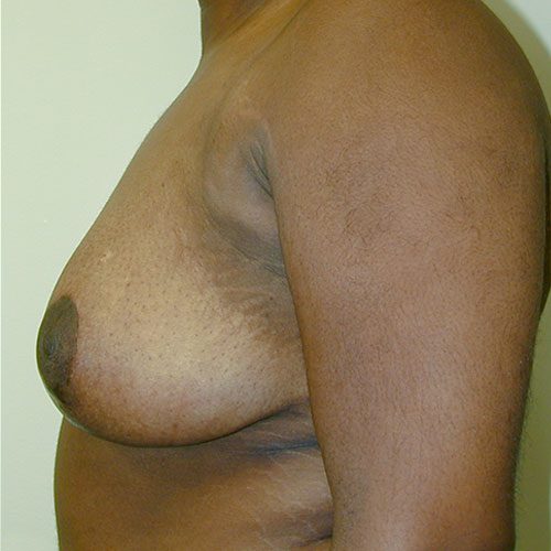 Breast Reduction 19 After Photo