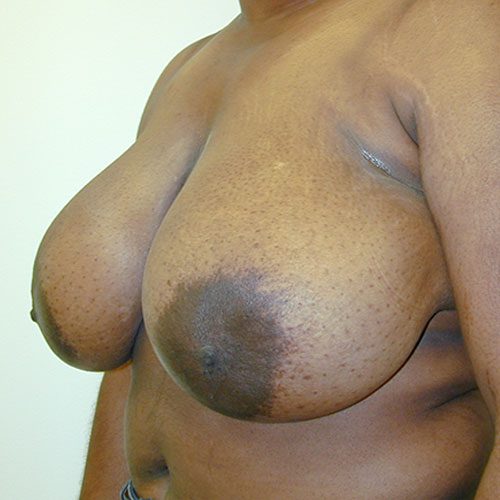 Breast Reduction 19 Before Photo