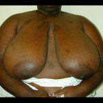 Breast Reduction 20 Before Photo - 7