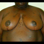 Breast Reduction 20 After Photo - 7