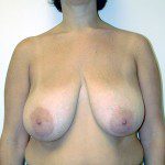 Breast Reduction 21 Before Photo - 6