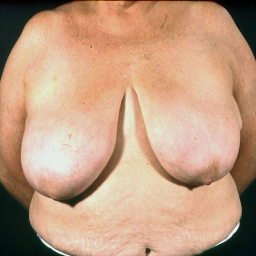 Breast Reduction 22 Before Photo 