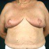 Breast Reduction 22 After Photo Thumbnail