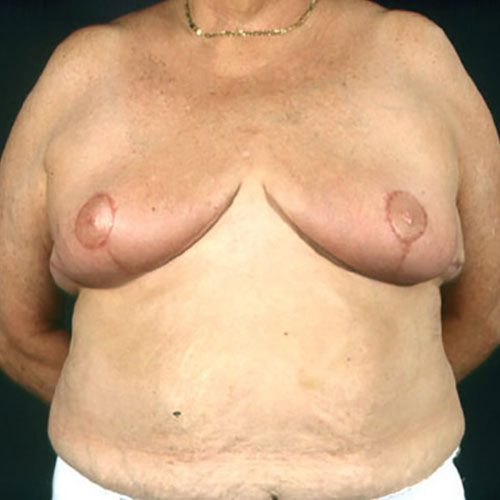 Breast Reduction 22 After Photo 