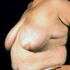 Breast Reduction 22 Before Photo Thumbnail