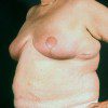 Breast Reduction 22 After Photo Thumbnail