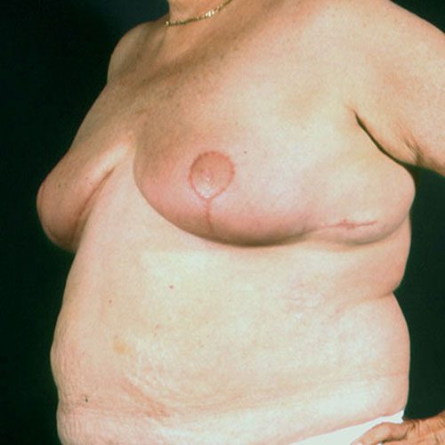 Breast Reduction 22 After Photo
