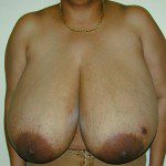 Breast Reduction 23 Before Photo - 4