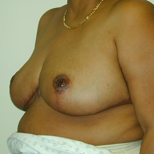 Breast Reduction 23 After Photo