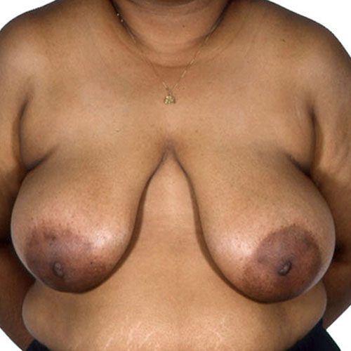 Breast Reduction 25 Before Photo 