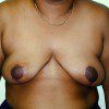 Breast Reduction 25 After Photo Thumbnail