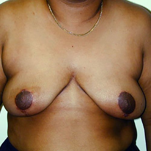 Breast Reduction 25 After Photo 