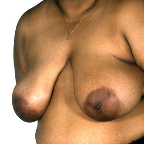 Breast Reduction 25 Before Photo