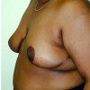 Breast Reduction 25 After Photo Thumbnail