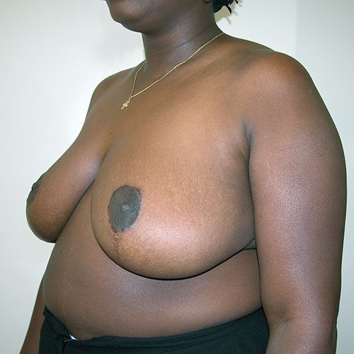 Breast Reduction 26 After Photo