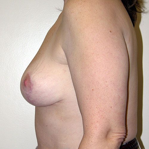 Breast Reduction 27 After Photo