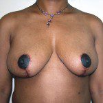 Breast Reduction 30 After Photo - 9
