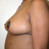 Breast Reduction 30 After Photo Thumbnail