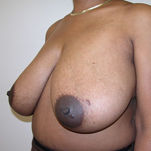 Breast Reduction 30 Before Photo
