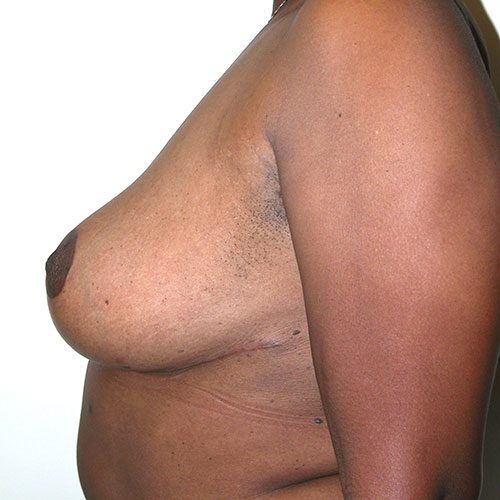 Breast Reduction 31 After Photo