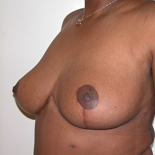 Breast Reduction 31 After Photo