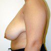 Breast Reduction 32 Before Photo Thumbnail