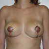 Breast Reduction 34 After Photo Thumbnail