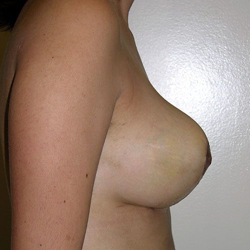 Breast Reduction 34 After Photo