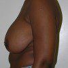 Breast Reduction 35 Before Photo Thumbnail