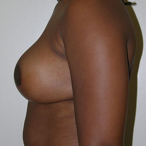 Breast Reduction 35 After Photo