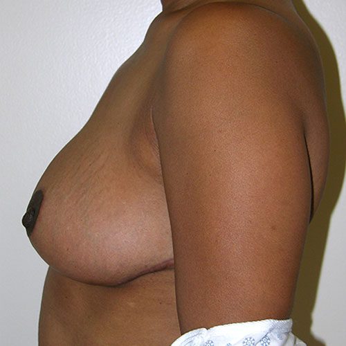 Breast Reduction 36 After Photo