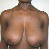 Breast Reduction 37 Before Photo Thumbnail