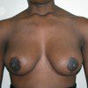 Breast Reduction 37 After Photo Thumbnail