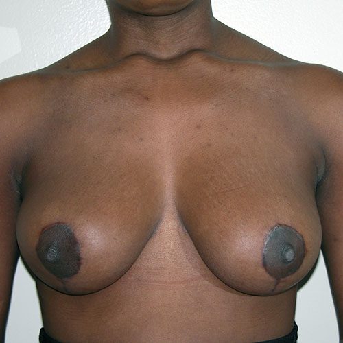 Breast Reduction 37 After Photo 