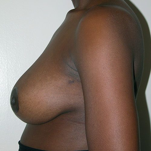 Breast Reduction 37 After Photo