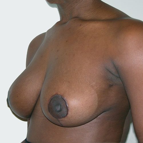 Breast Reduction 37 After Photo