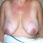 Breast Reduction 38 Before Photo - 1