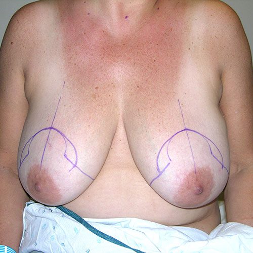 Breast Reduction 38 Before Photo 