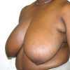 Breast Reduction 39 Before Photo Thumbnail