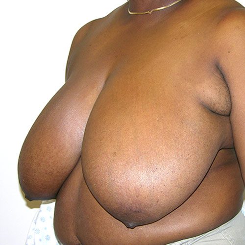 Breast Reduction 39 Before Photo
