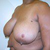 Breast Reduction 40 Before Photo Thumbnail