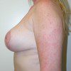 Breast Reduction 42 After Photo Thumbnail