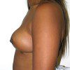 Breast Reduction 43 After Photo Thumbnail