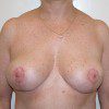 Breast Reduction 44 After Photo Thumbnail