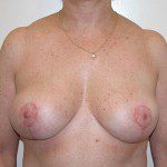 Breast Reduction 44 After Photo - 7
