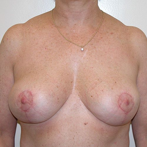 Breast Reduction 44 After Photo 