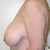 Breast Reduction 44 Before Photo Thumbnail